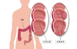 腸息肉會癌變嗎？腸鏡檢查出腸息肉千萬別大意！