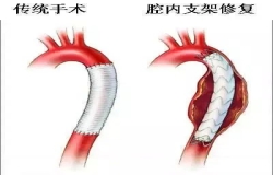 《問心》熱播！全網(wǎng)熱議的主動脈夾層，您了解嗎？