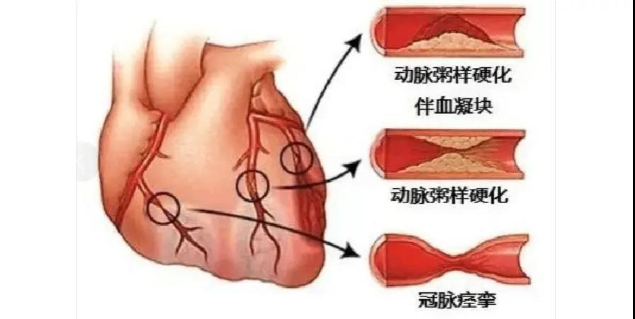 冠心病患者注意了，專業(yè)醫(yī)生為您盤點那些堅決不能停的藥！
